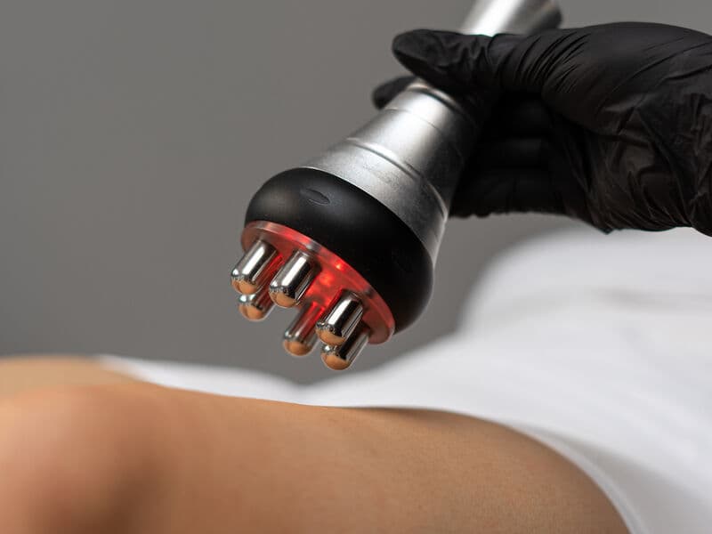 Liposukcja kawitacyjna — zabieg